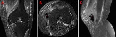 Unicompartmental Knee Arthroplasty for Knee Osteoarthritis With the Pellegrini–Stieda Lesion: A Case Report